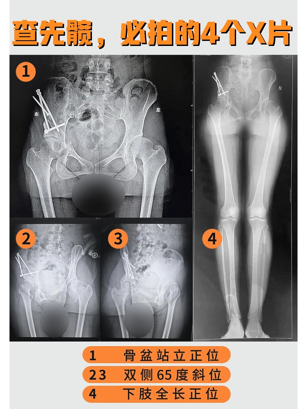 查先髋必拍的4个x光片