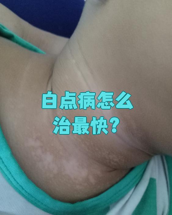 如果刚发病出现白斑,可以用糖皮质激素药膏涂抹