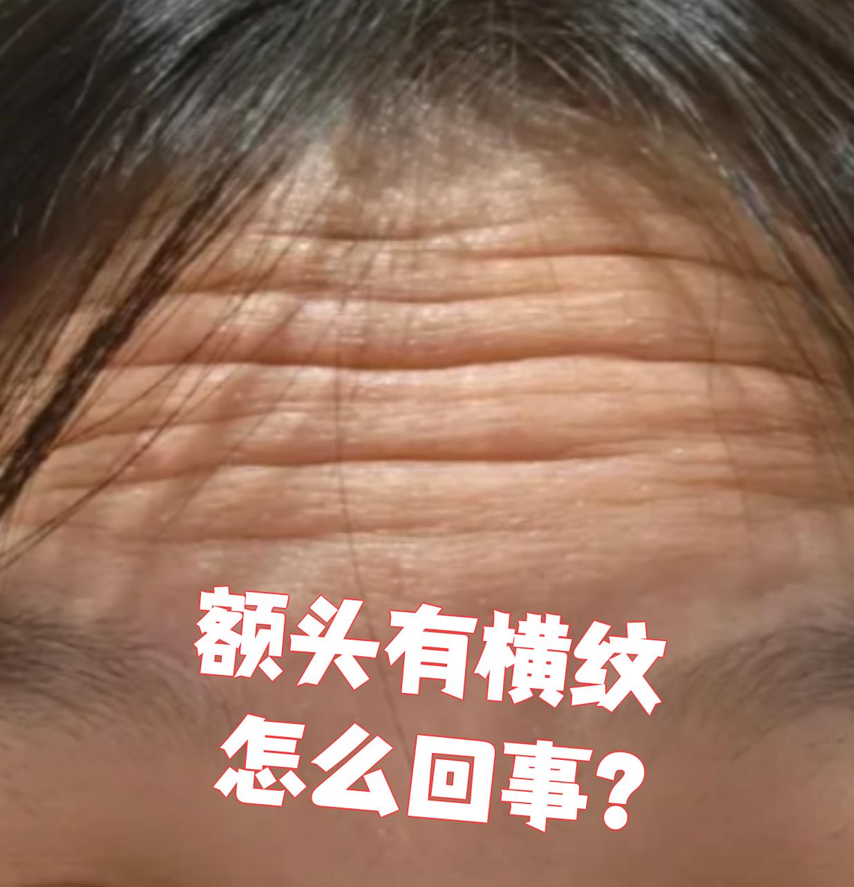 额头出现横纹最常见的就是抬头纹,这主要和年龄增长,皮肤松弛或者