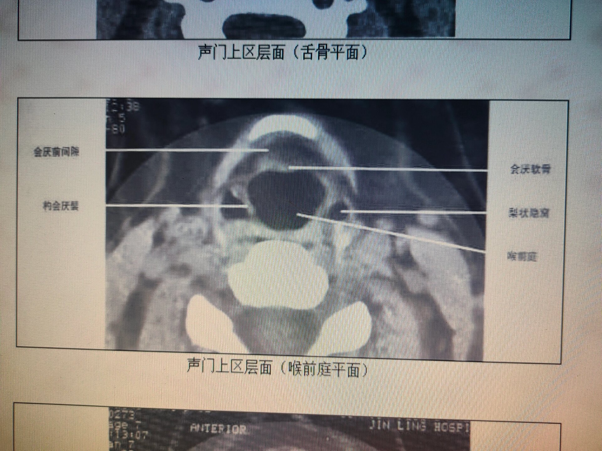 声门CT图片