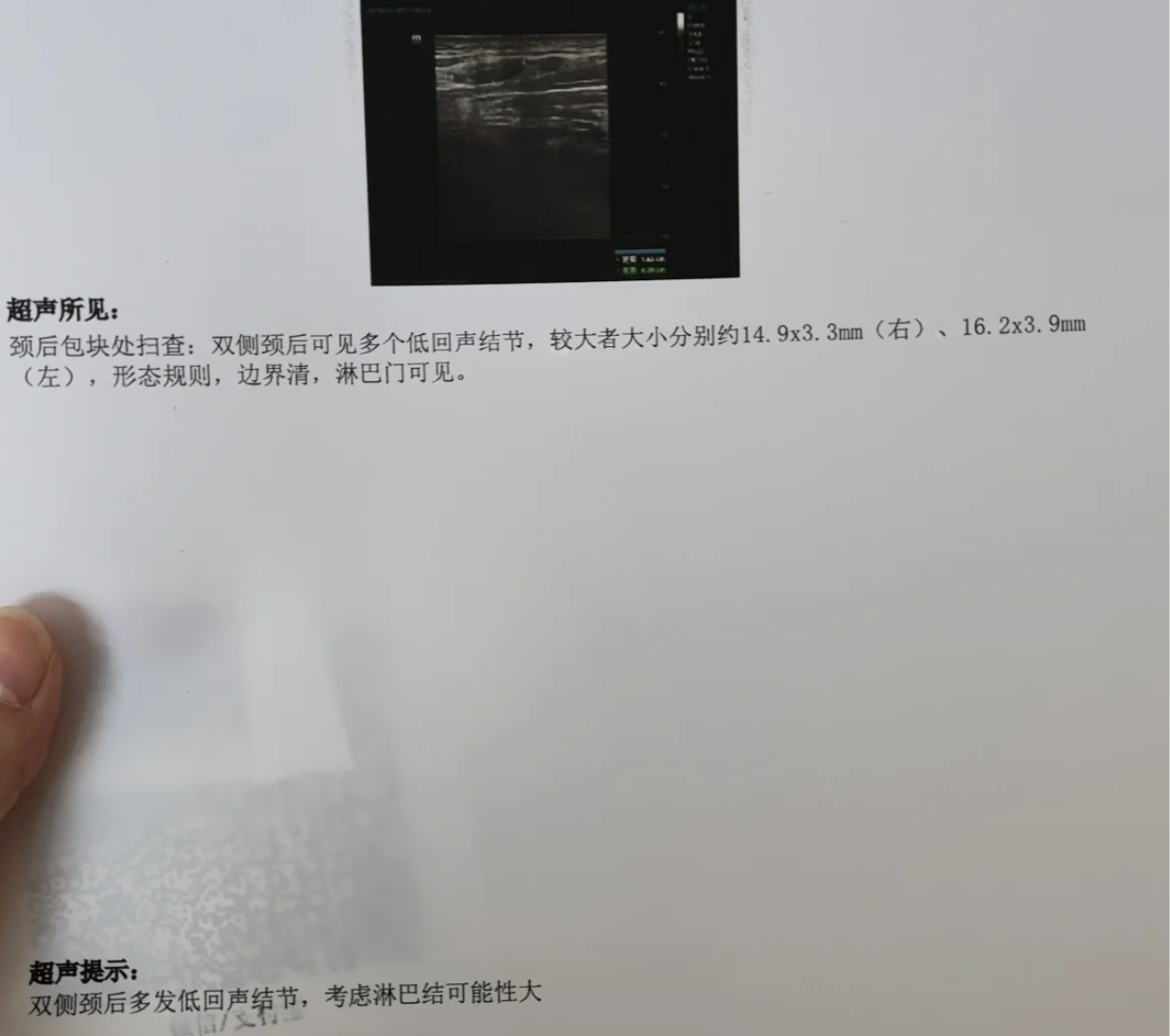 正常情况下,这些淋巴结是摸不到的