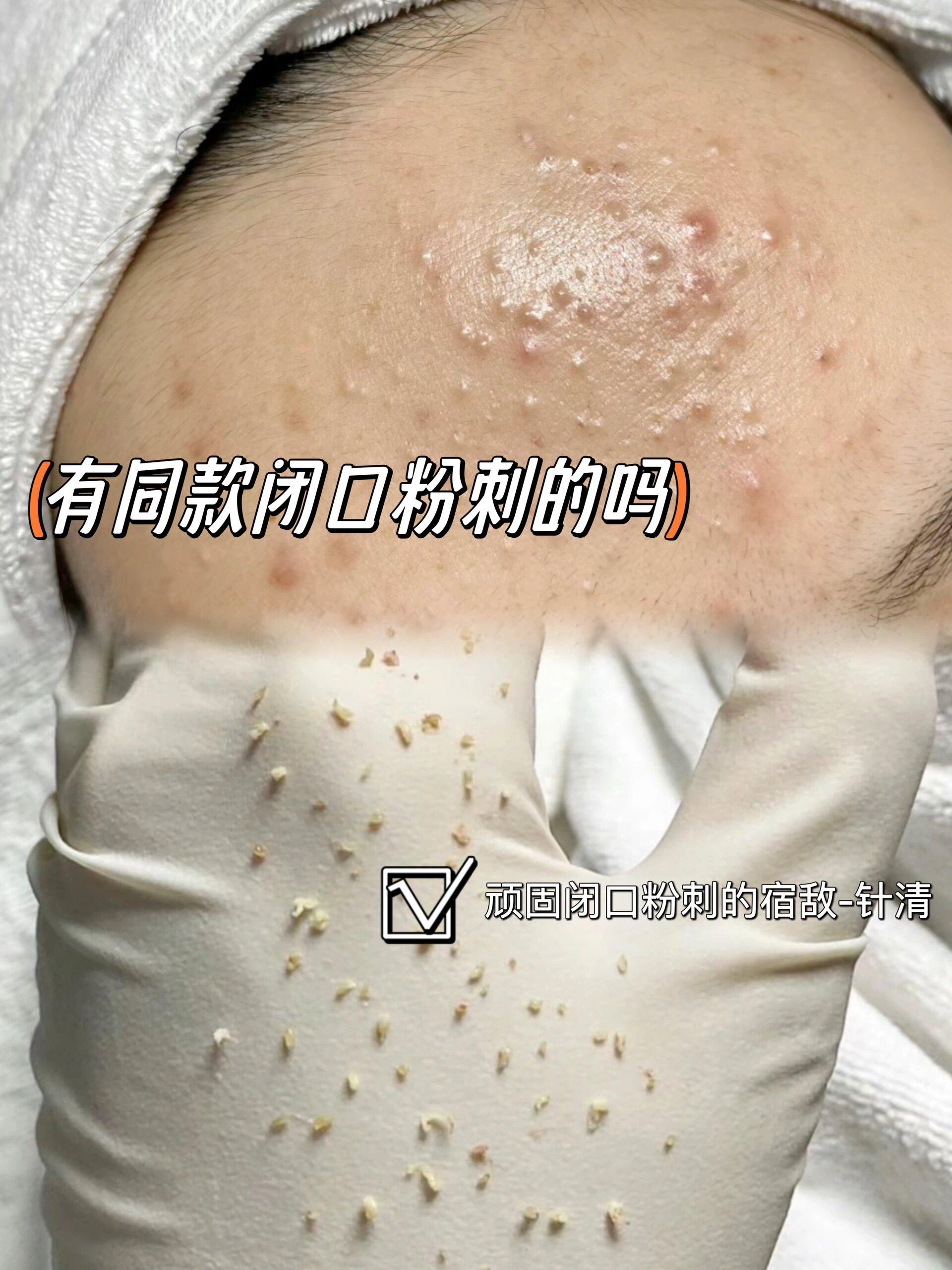 宁波皮肤管理|闭口粉刺的宿敌-针清 看看这些颗粒饱满的粉刺闭口 每一