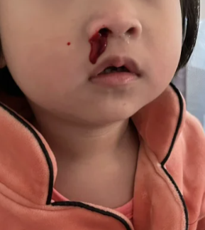 一哭就流鼻血该怎么办?