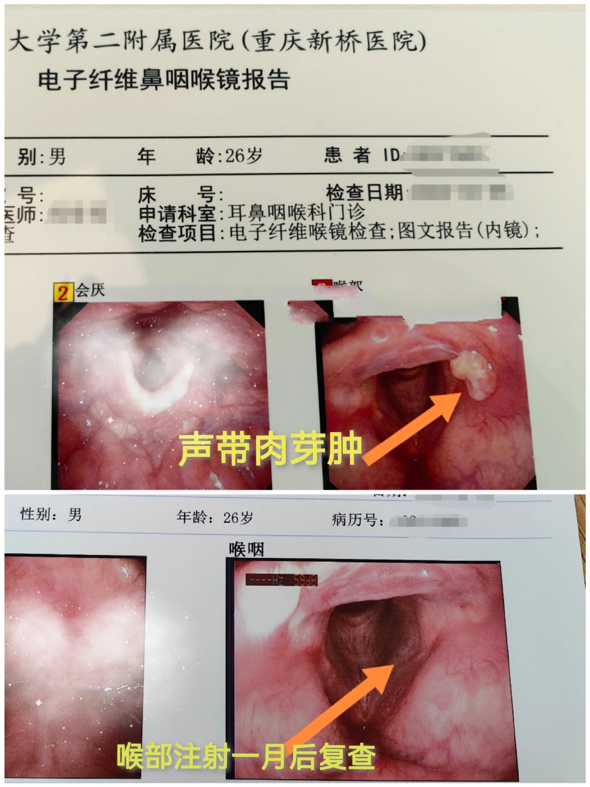 男性声带肉芽肿一针消失的例子比女性少多了 五一出游的,五一就医的