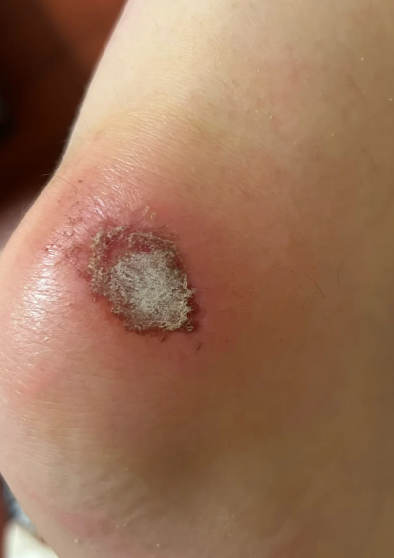 伤口起白色的疤主要有三个原因:伤口渗出物,化脓性感染和疤痕形成