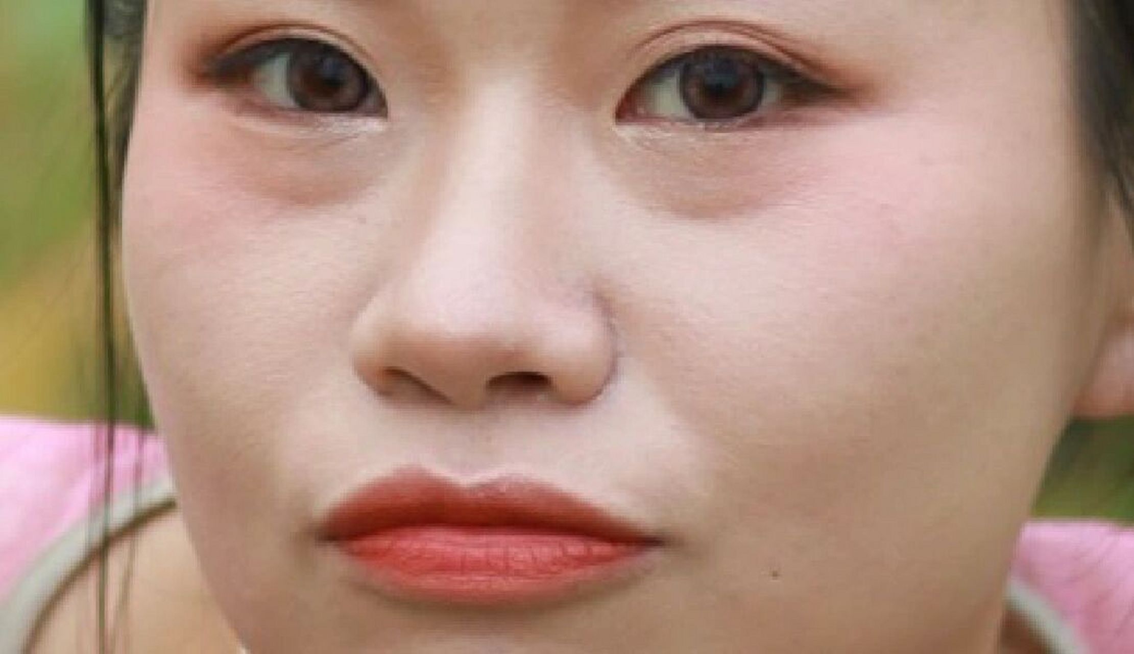 坐标南昌二附割眼袋泪沟 本人天生的大眼袋,年纪增长越来越明显,特别