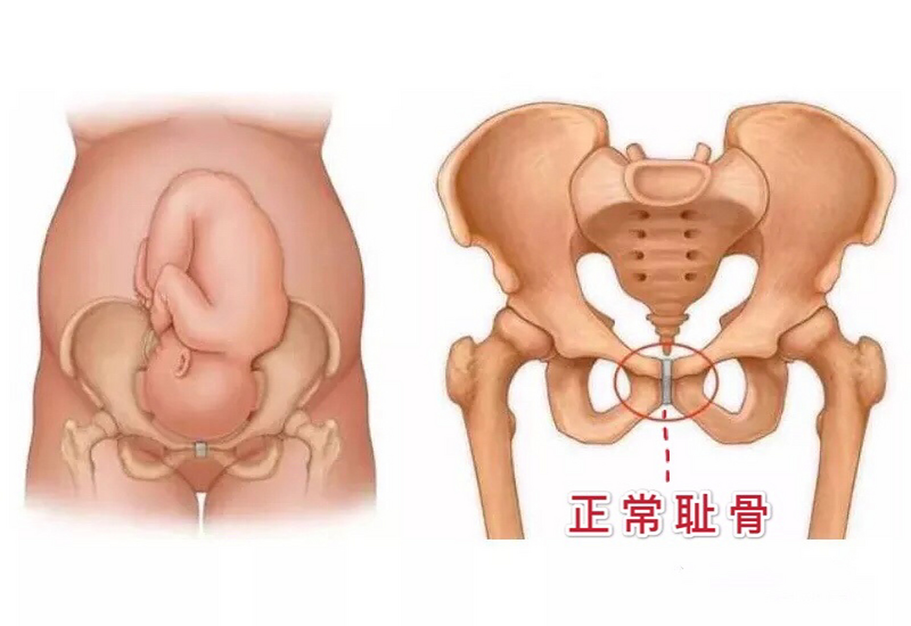 我们先来了解哪里是耻骨(图三,四) 耻骨在小腹和大腿根部的交接处