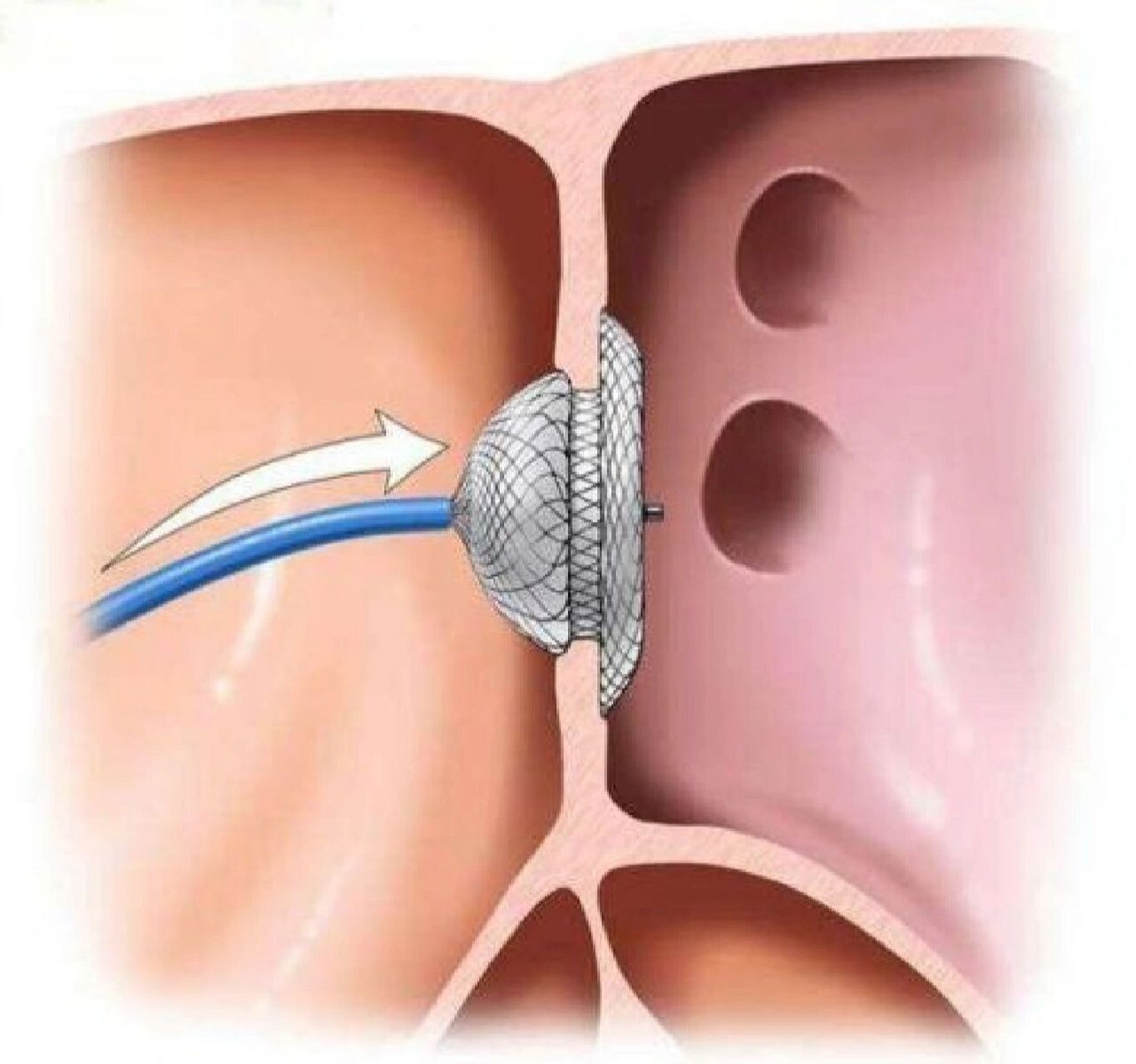 卵圆孔未闭合——偏头痛77 98很多人问,什么算偏头痛,但我不是