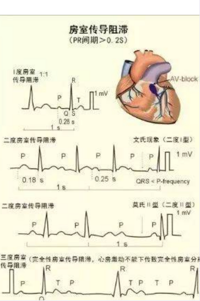 大家好,我是曲家珍医生,最近很多人体检,查出了心脏房室传导阻滞的