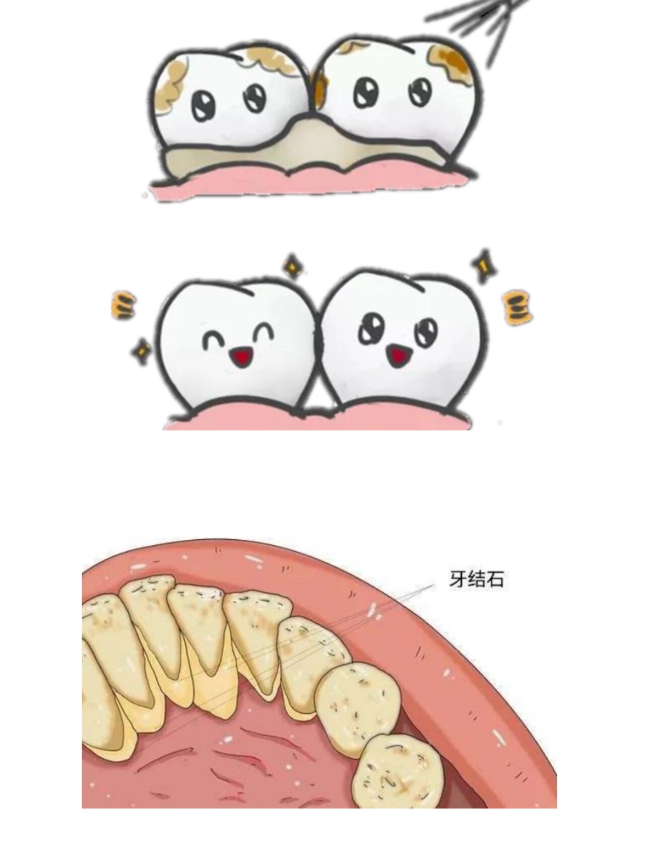 什么是牙结石 牙结石是指正在钙化或已经钙化的菌斑及软垢,沉积在