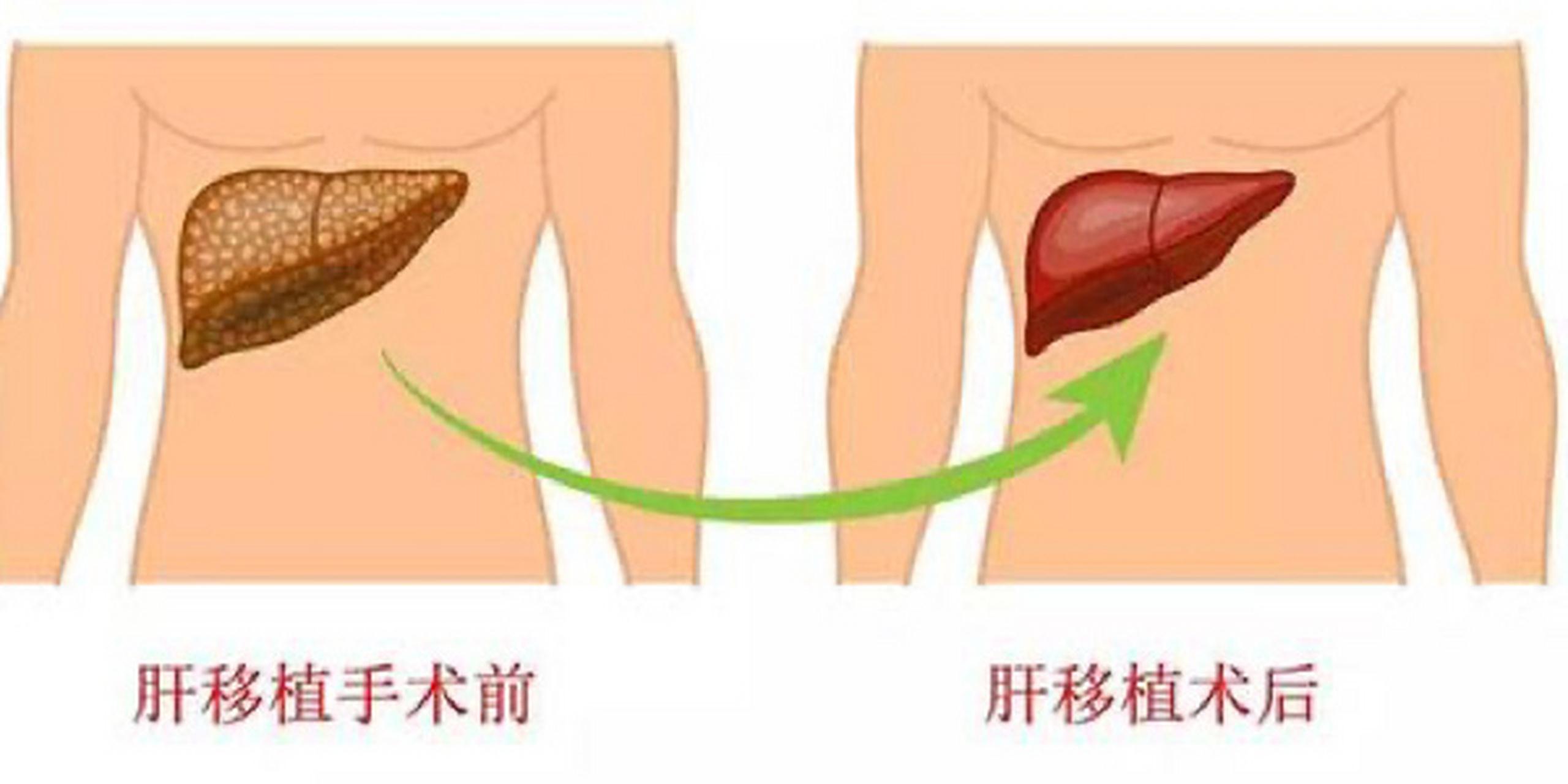 肝移植费用少则20万左右,多则100万左右,需要50人左右的医疗团队为之