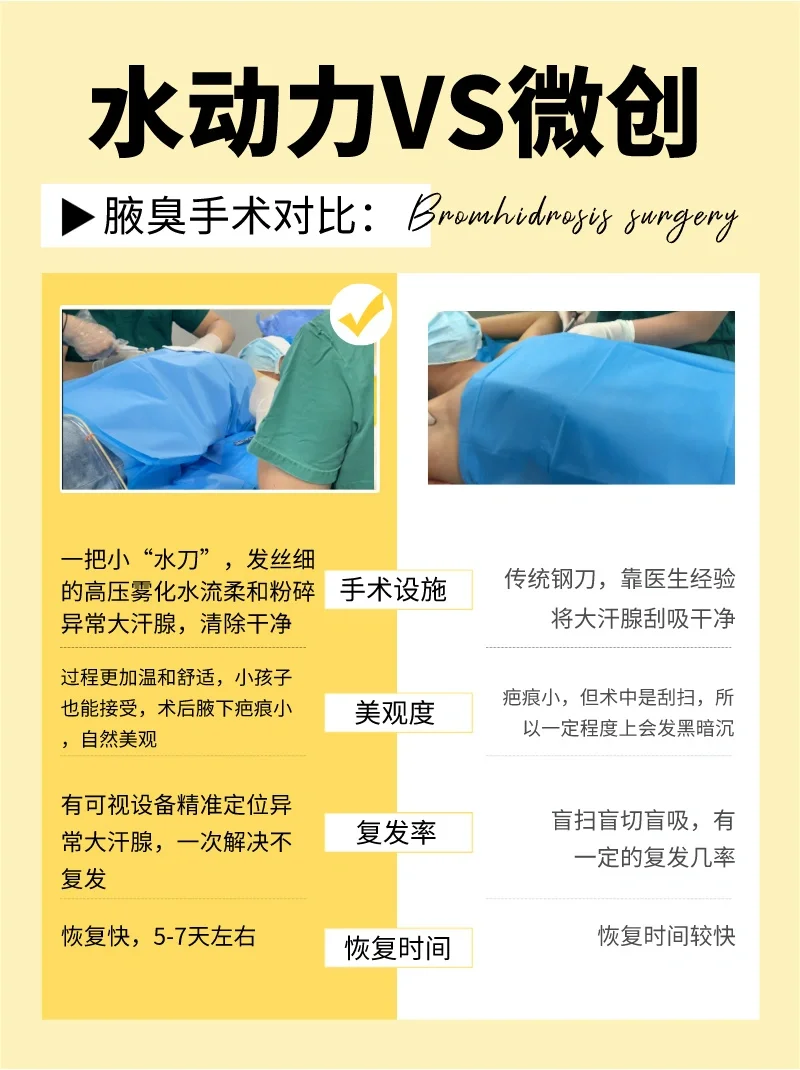 普通微创和水动力腋臭手术对比 很多有腋臭的朋友来问马主任说:普通的
