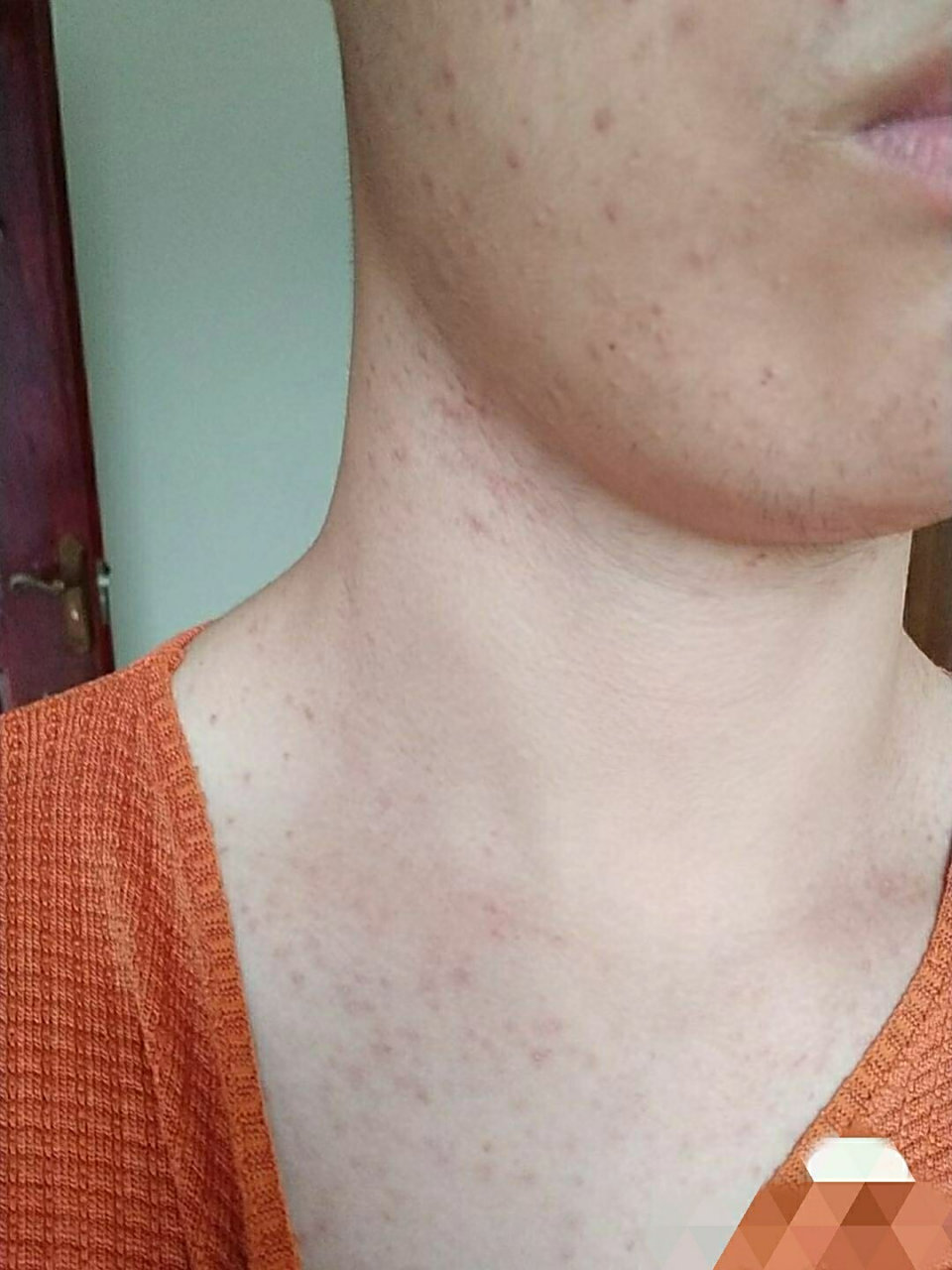 糠秕孢子菌毛囊炎快好了,真开心97