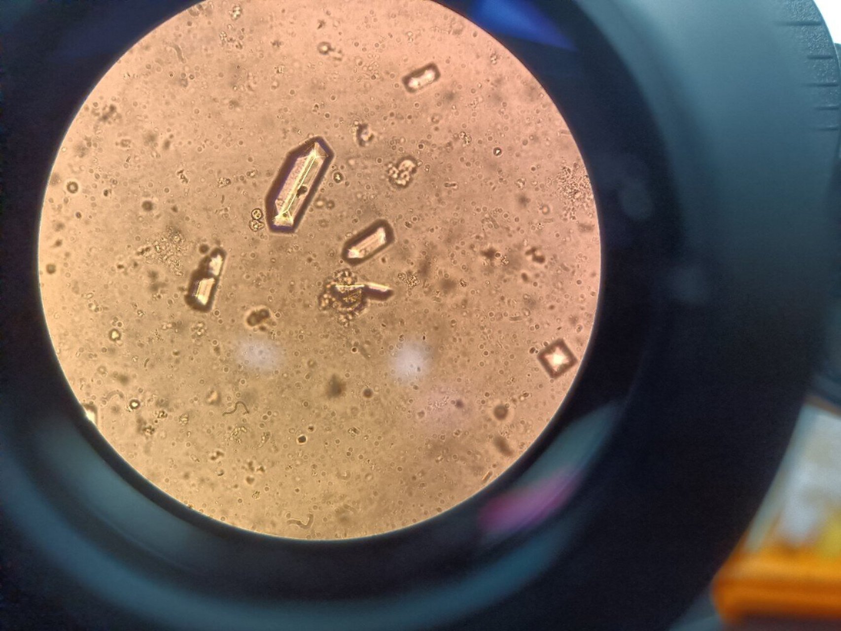 [尿镜检]磷酸钙结晶 常见于弱碱性尿,中性尿有非结晶形,粒状形,三棱形