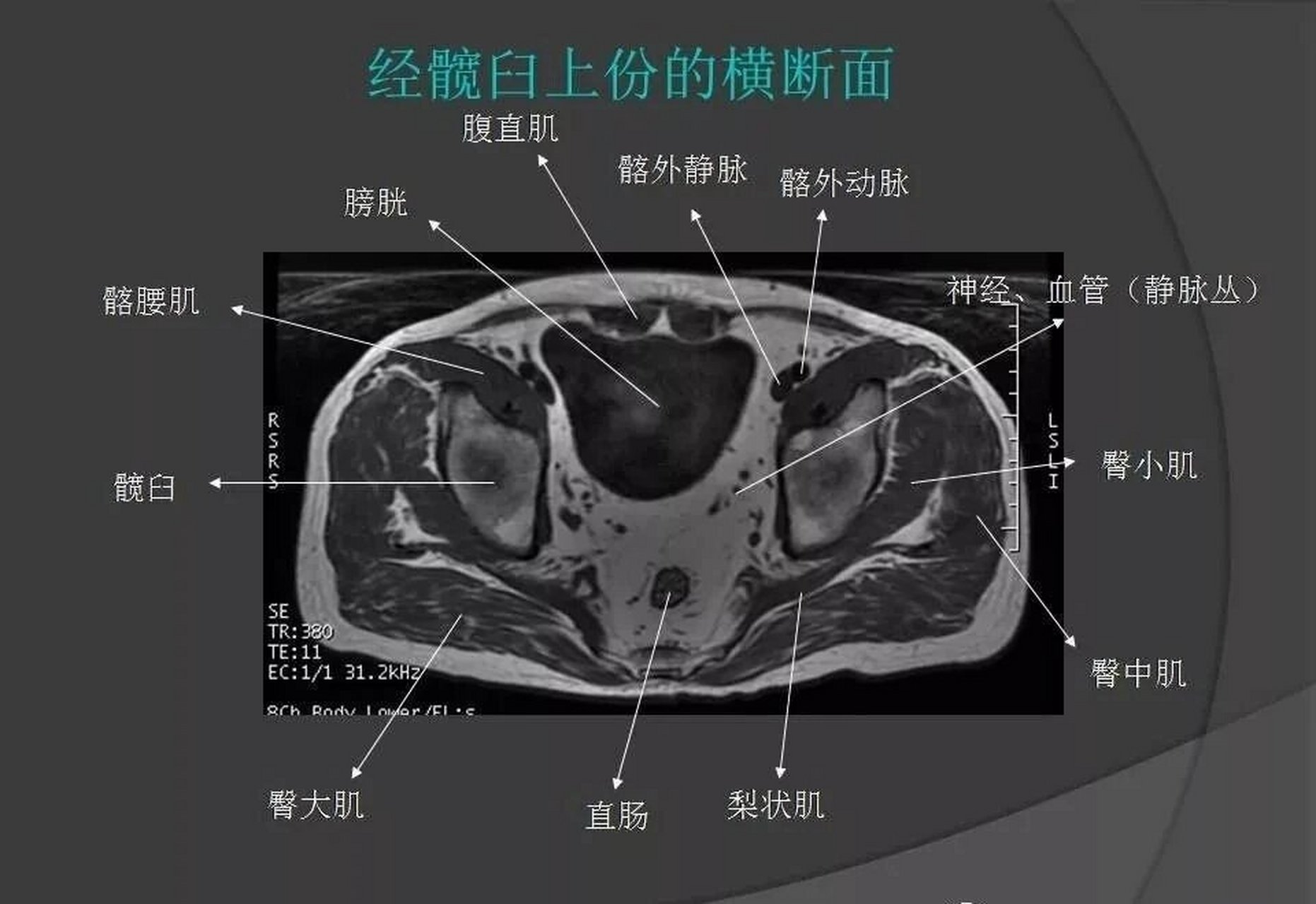 骨盆肌肉解剖图横断位图片