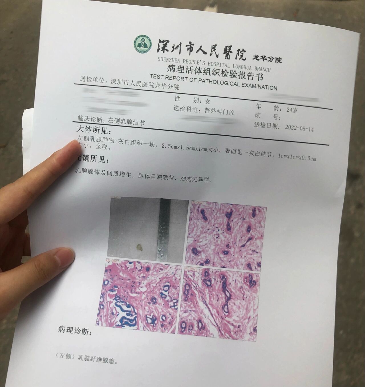 乳腺纤维瘤病理结果出来啦!