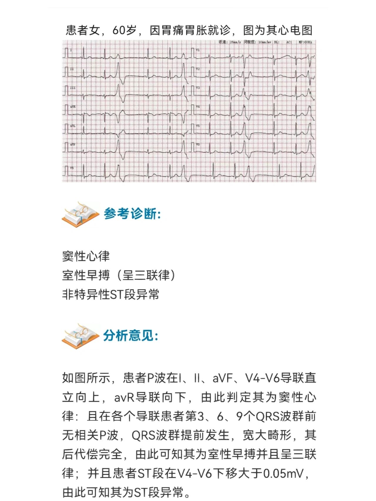 室性早搏三联律心电图图片