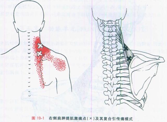 肩胛提肌损伤图片