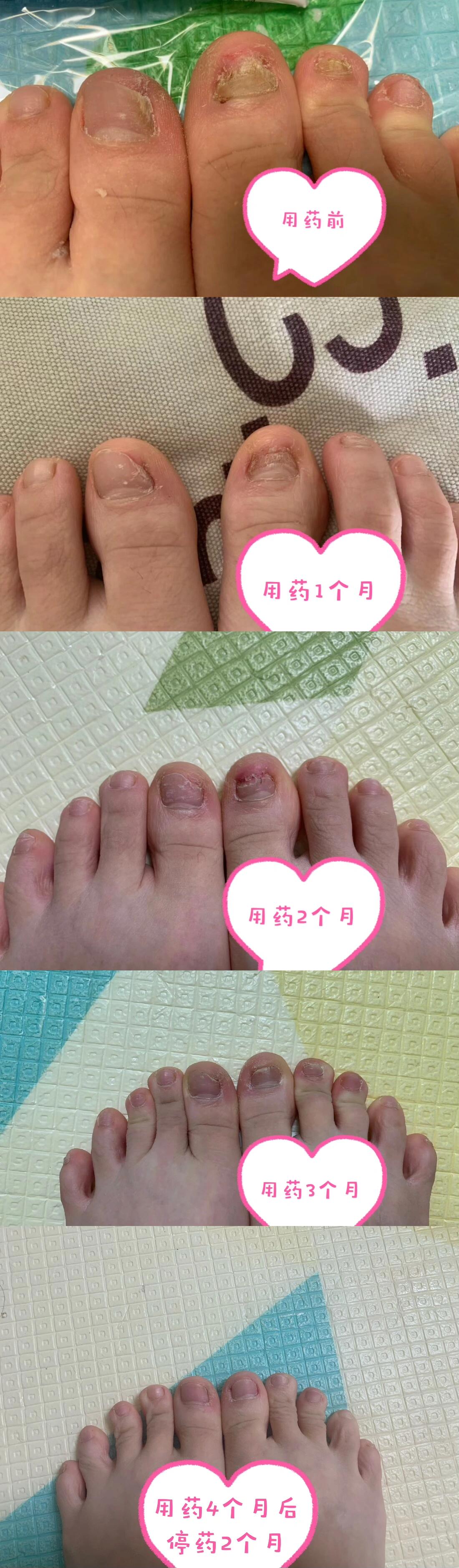 灰指甲不用怕,正规治疗