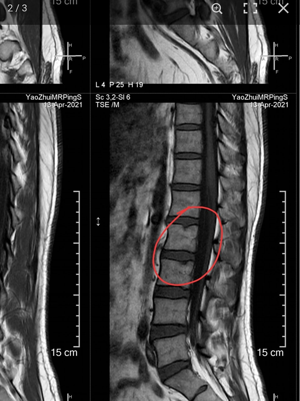 有一种腰椎病名叫:许莫氏结节