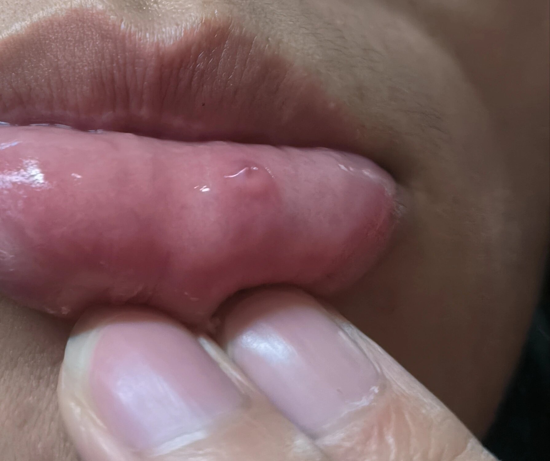 嘴唇里面起了一个透明水泡.@小东同学谈健康的动态