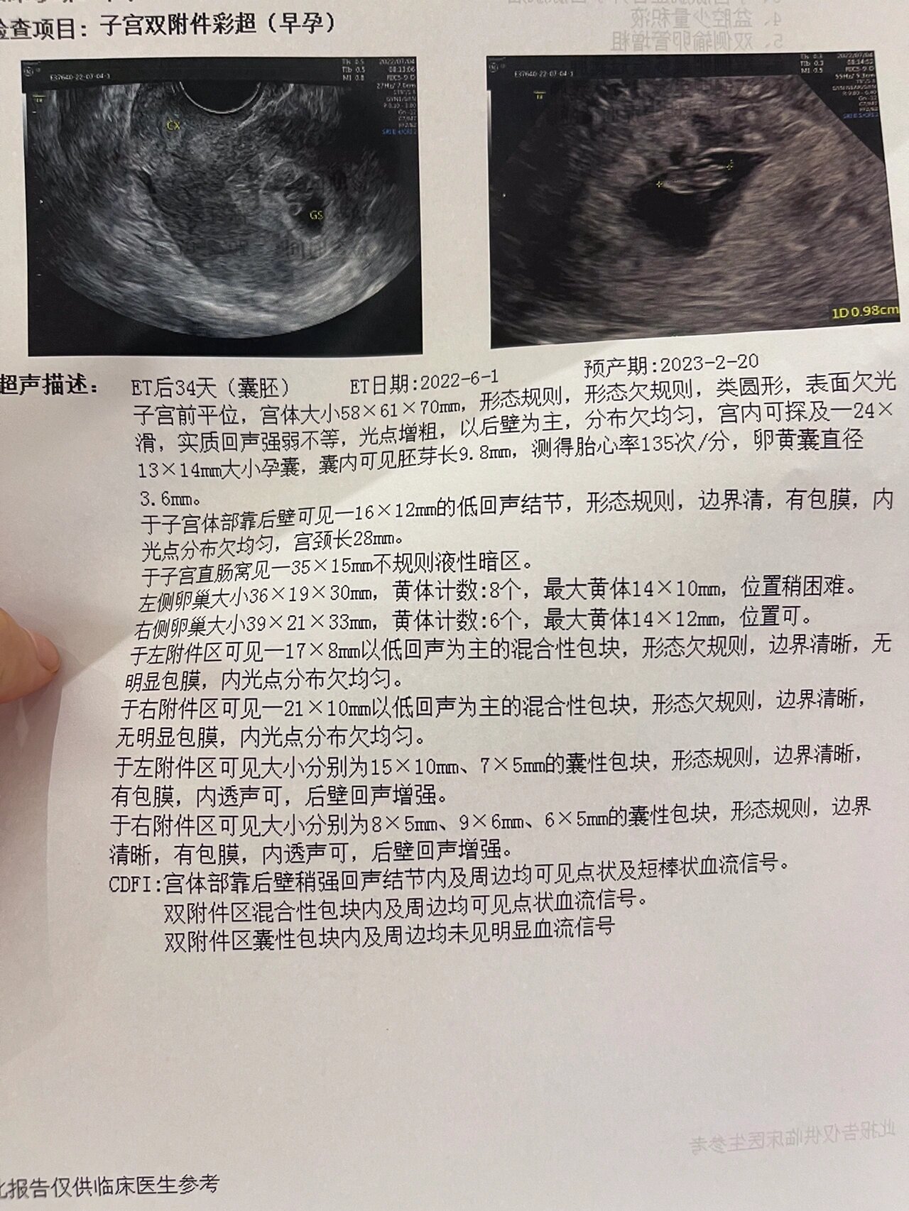 保胎日记囊胚移植34天结果出炉