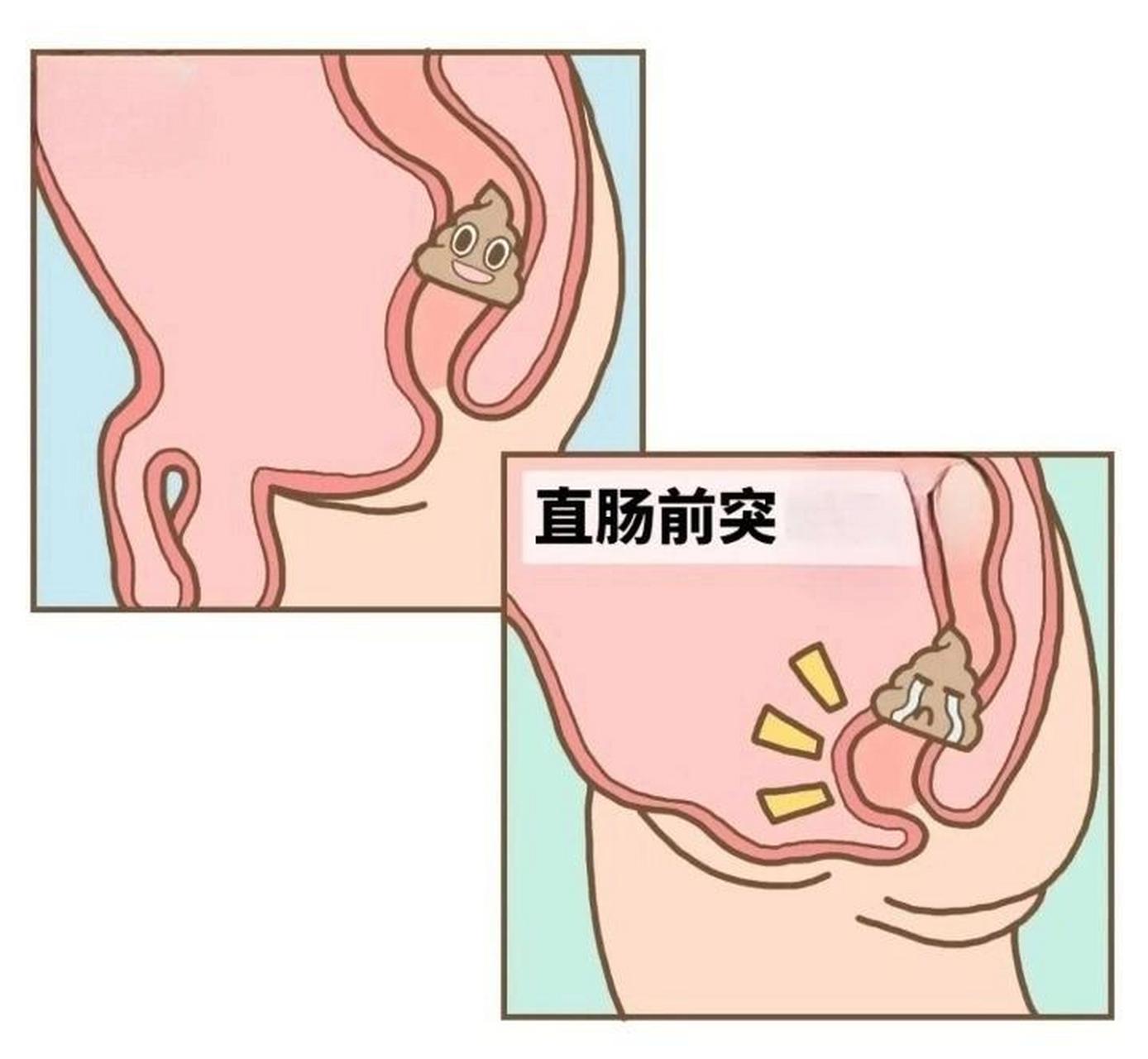 直肠前突最佳治疗方法图片