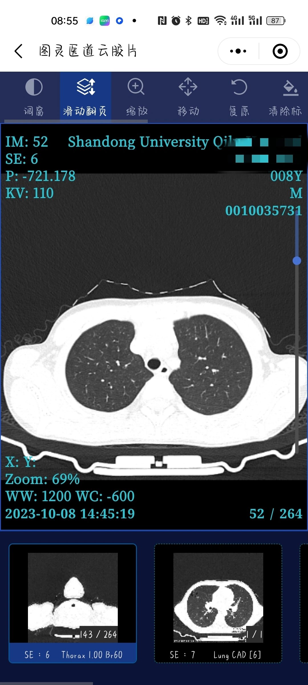 孩子支原体肺炎ct 孩子2021年得过大叶性肺炎,左肺上半叶全部变白,做