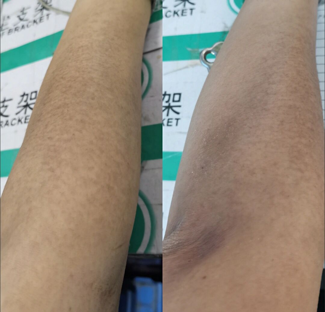 有没有好的方法推荐分享给我,这个黑色素困扰我好久,夏天尴尬.