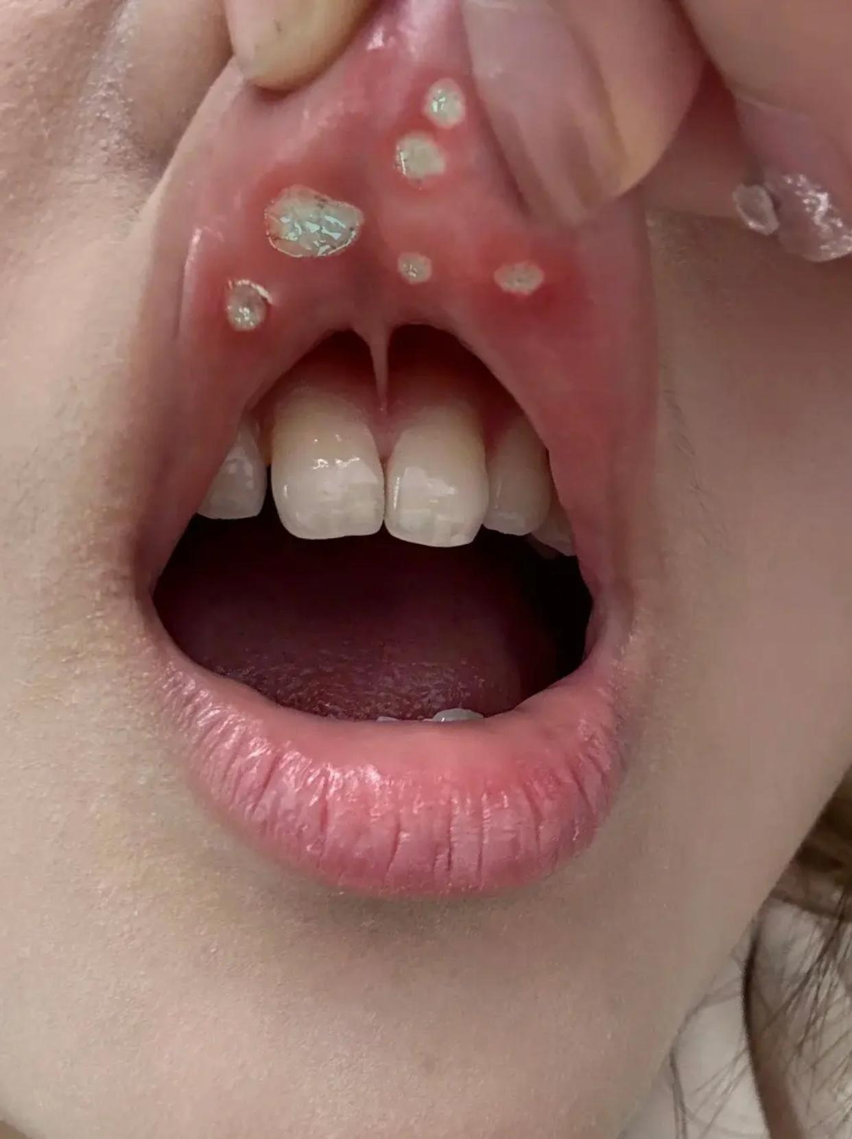 坚持这么久,胃好多了,现在能吃能喝,但是最近口腔溃疡一周了,还不好