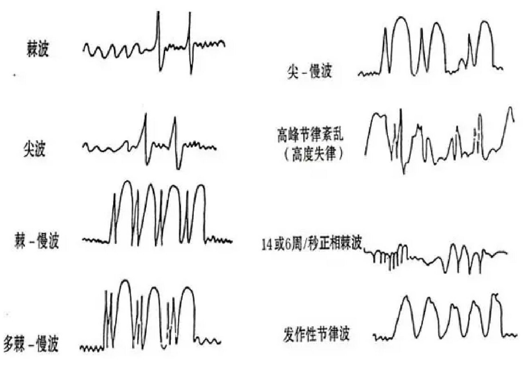 脑电图异常波解读图片