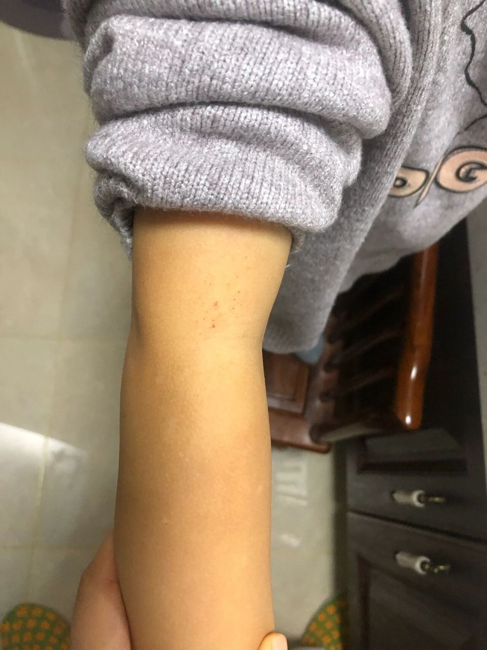 宝宝 手上出现白斑!