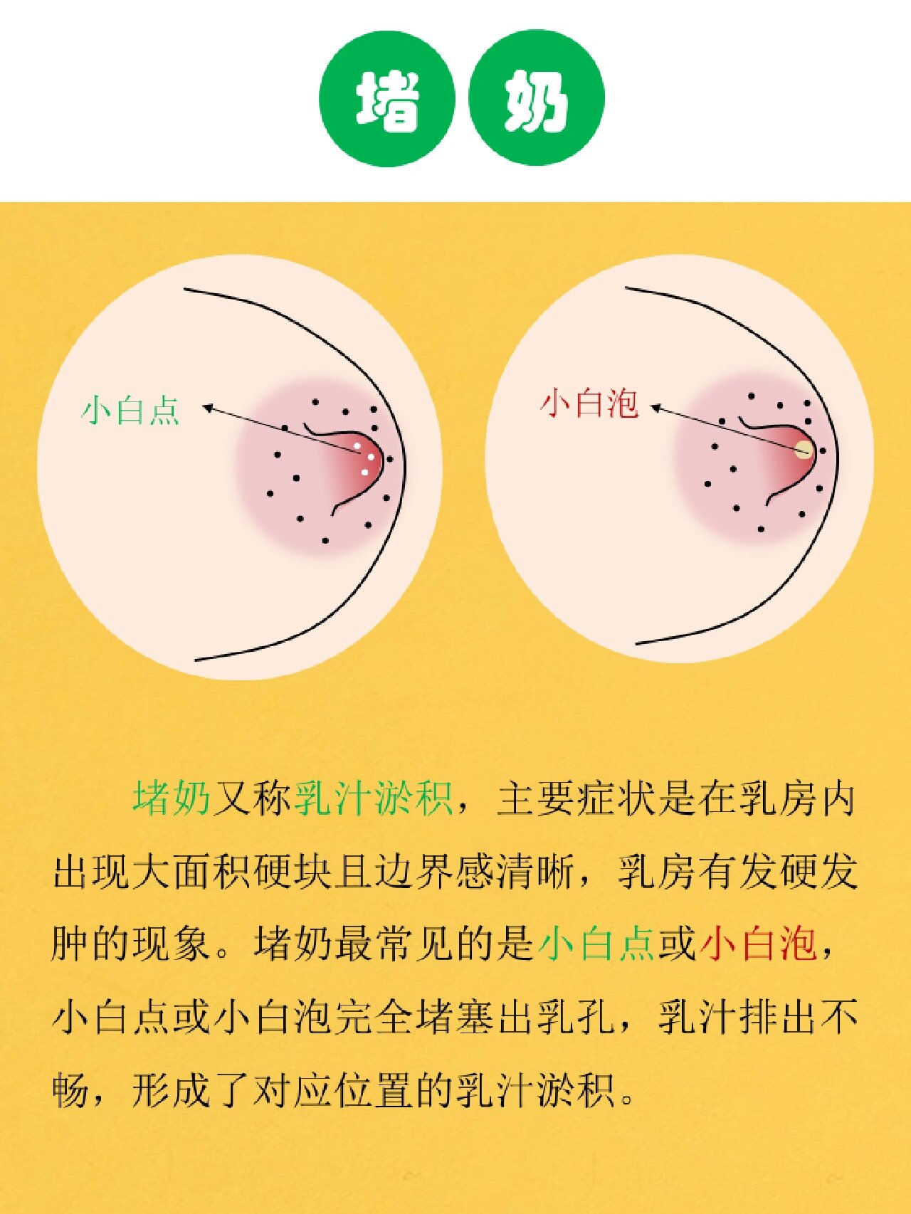 乳头小白点造成的堵奶怎么处理?