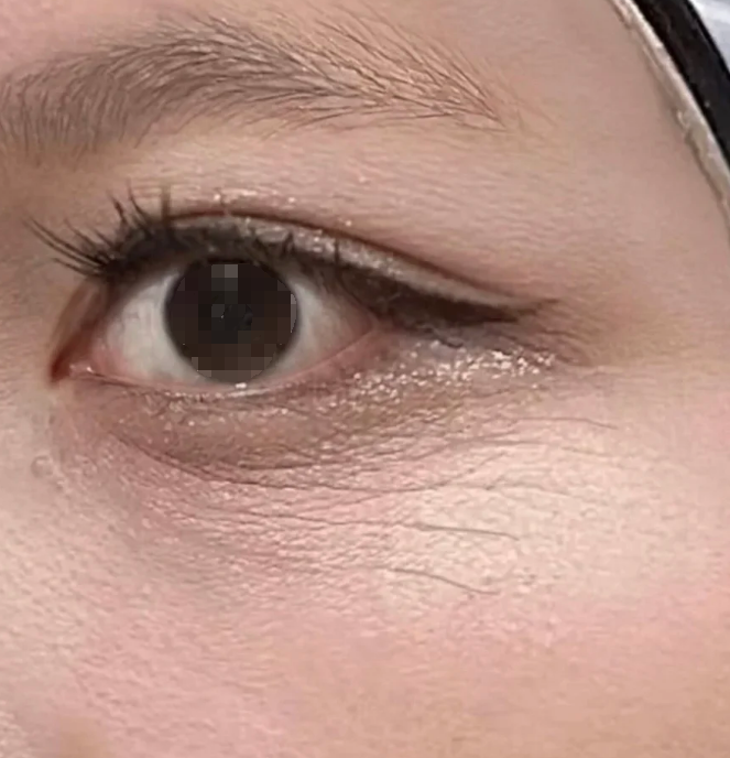 眼睛下面的皱纹主要有三种原因:动态纹,静态纹和紫外线损伤