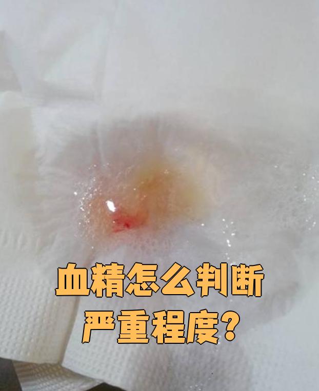 血精也叫血精症,判断它的严重程度主要看三点:出血量,颜色和原因