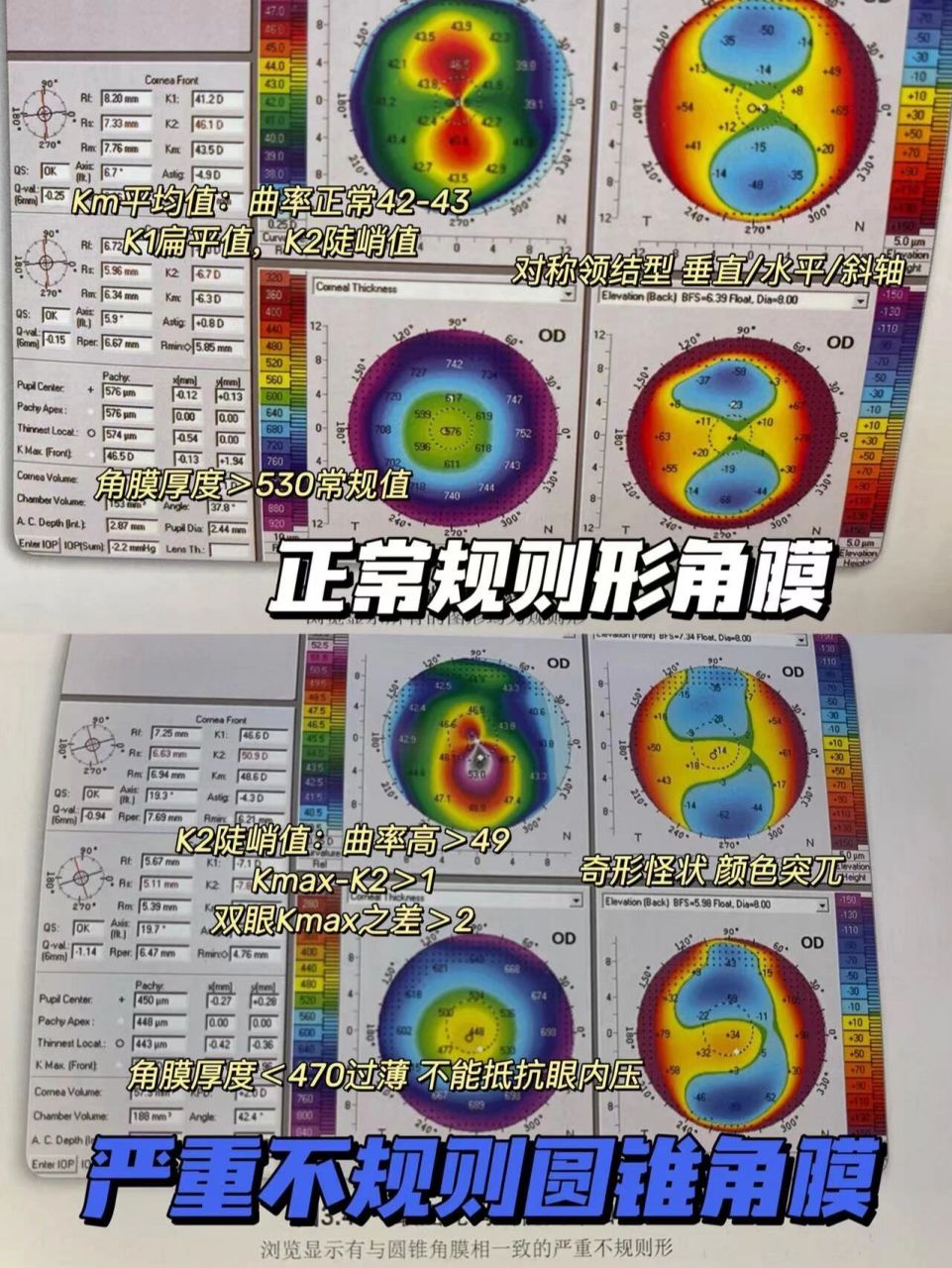 护士笔记丨pentacam角膜地形图怎么看 很多姐妹做近视手术术前检查的