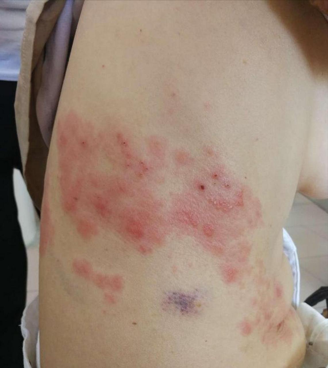 那八九不离十就是"中招"了带状疱疹,也是大家说的"蛇缠腰"