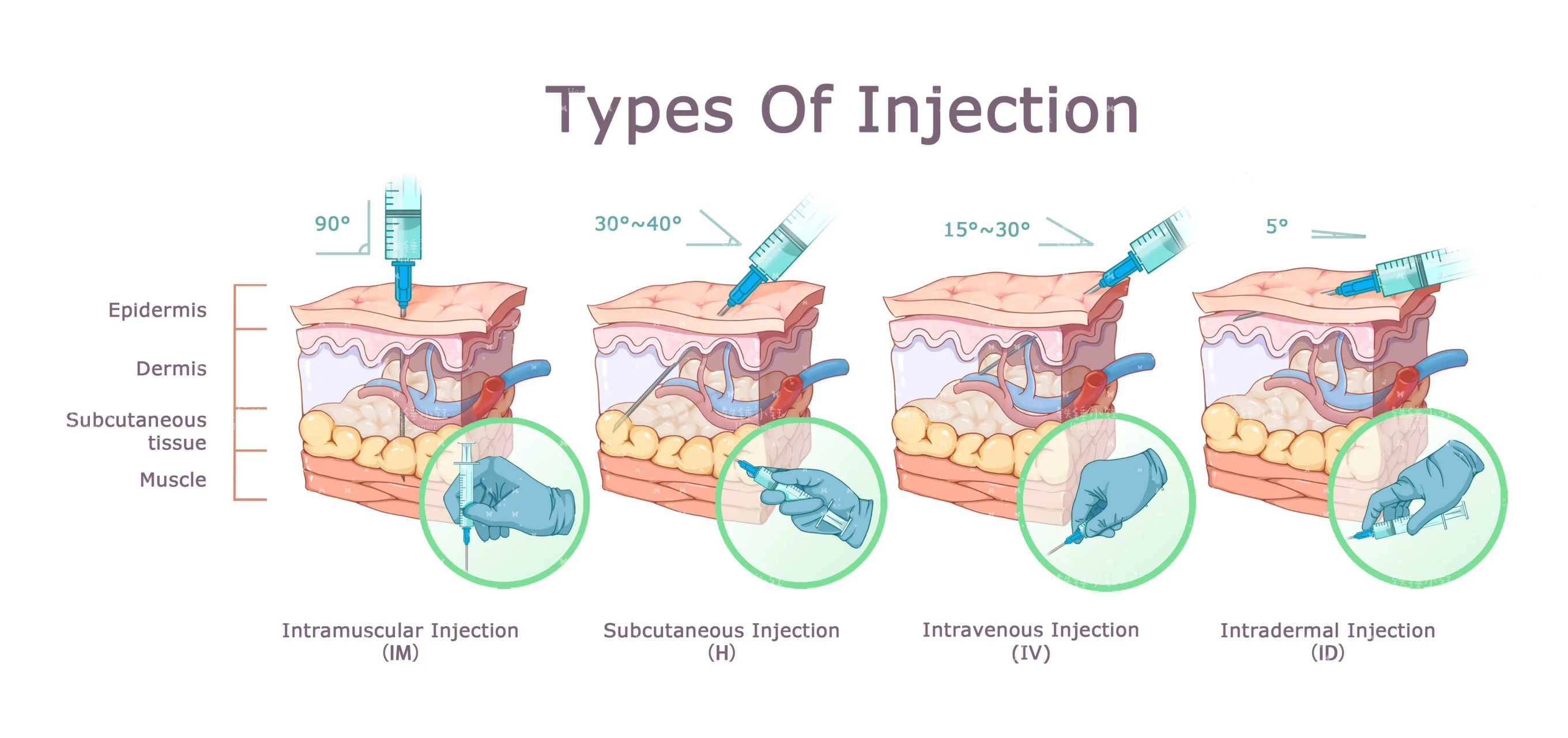 四大注射的角度图片