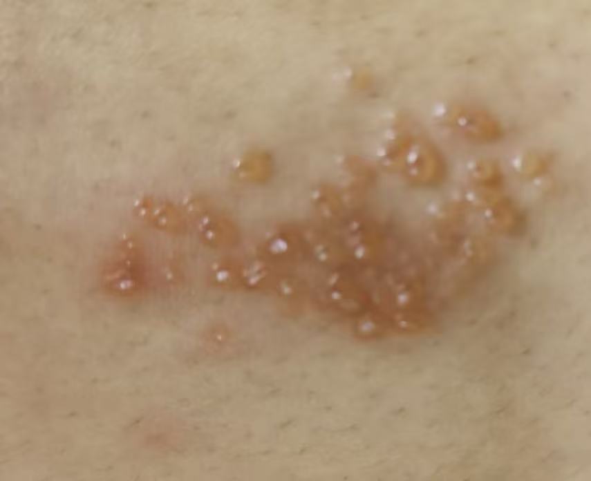 为什么起水泡总是在秋季出现百科在线