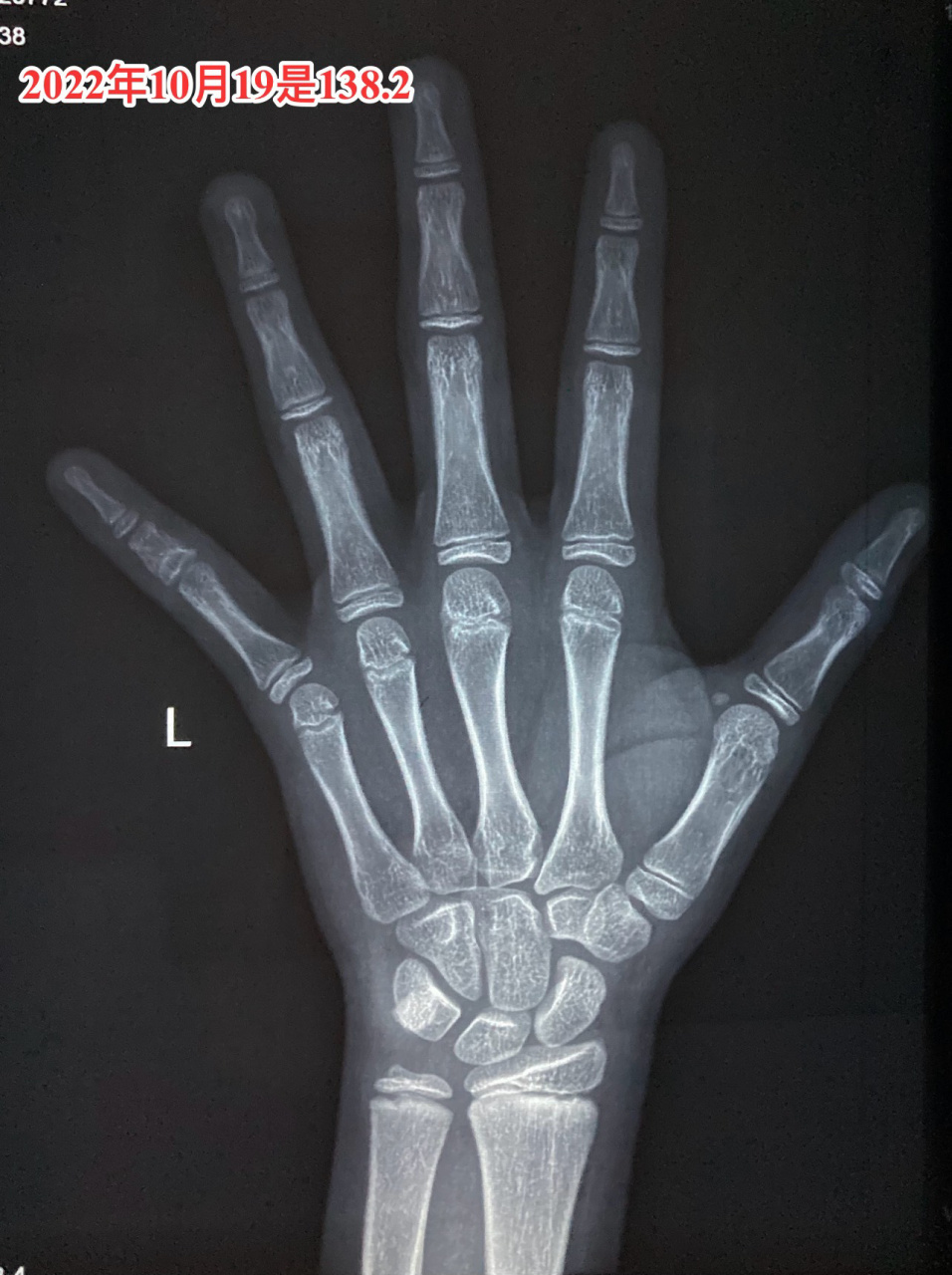 差点又被骗了,籽骨出现不一定是11岁骨龄 差点又被骗了,籽骨出现不