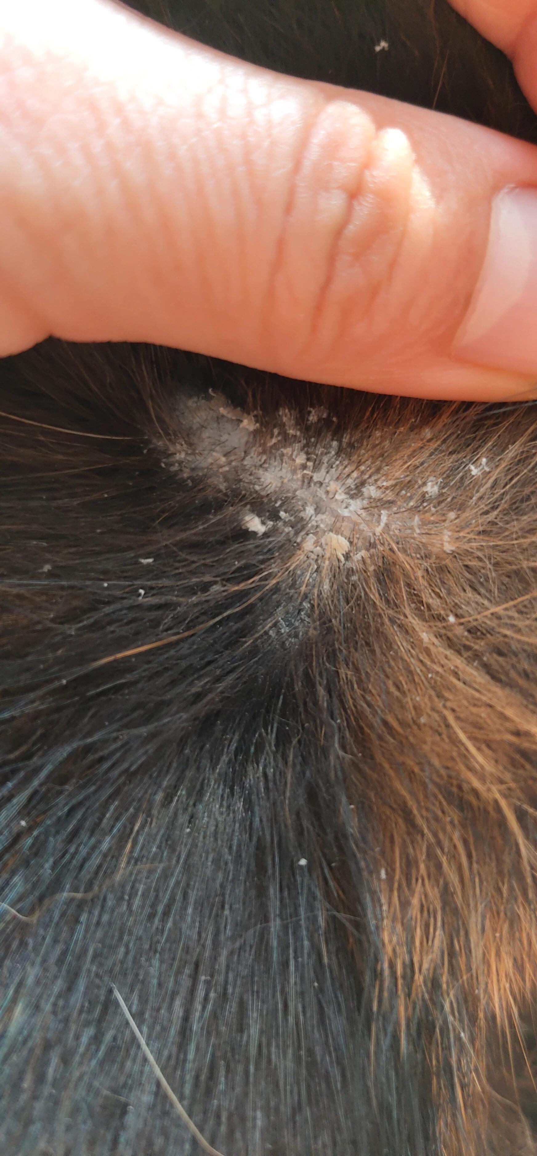 猫皮肤病 皮屑 9月七号发现的马上一个月了 消炎药 鱼油 擦碘伏 喷药