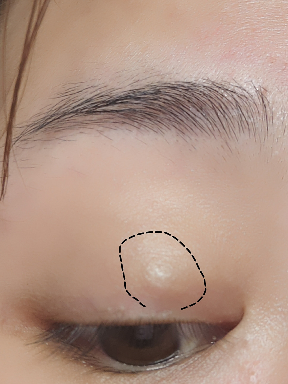 集美们,有谁知道眼睛这个小疙瘩怎么消下去?