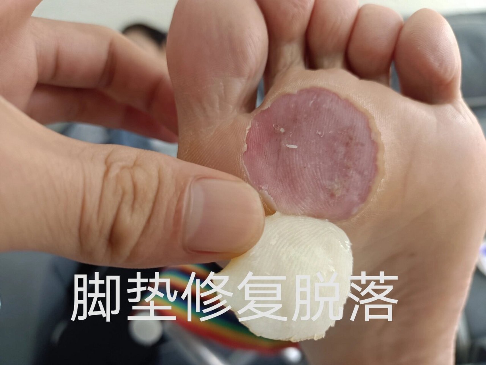 有脚垫特别难受,一走路就疼