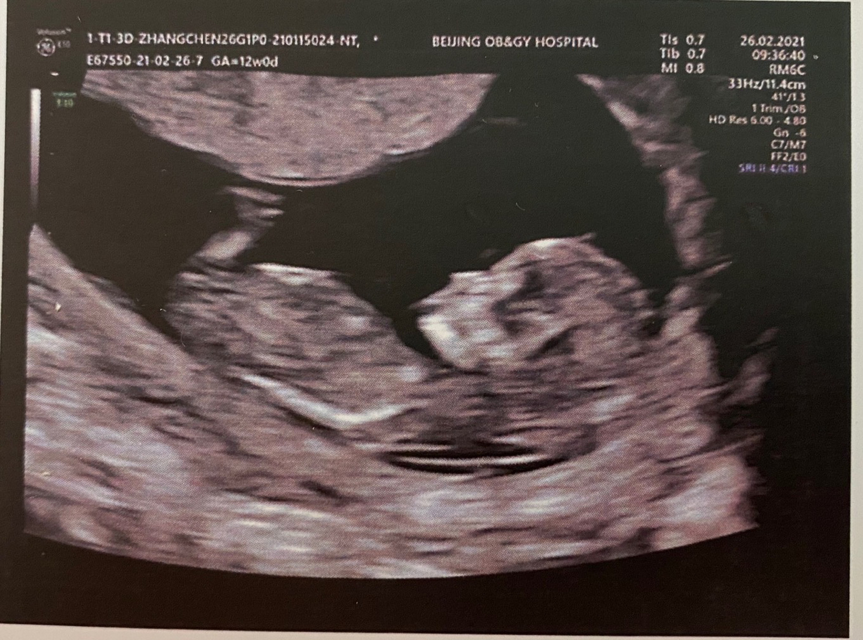 12周nt,来猜猜男女～ 今天12周整,去做nt,结果做了好久,医生说宝宝倒