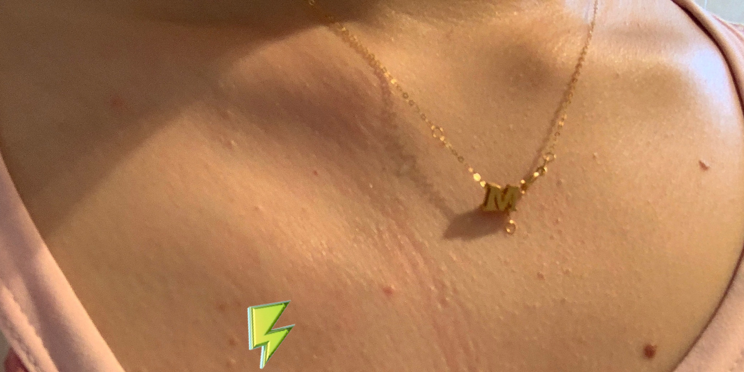 右侧锁骨下方突然就鼓出来了 有没有人也这样右侧锁骨下方突出的,好慌