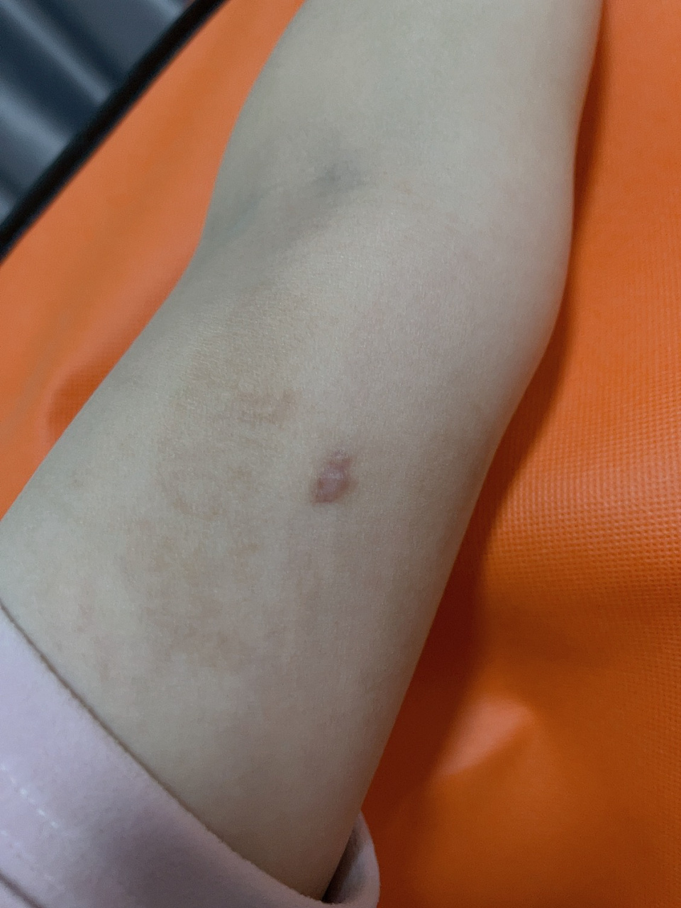 你们关心的皮埋 亲身感受 我终于取掉了四个多月的皮埋避孕!