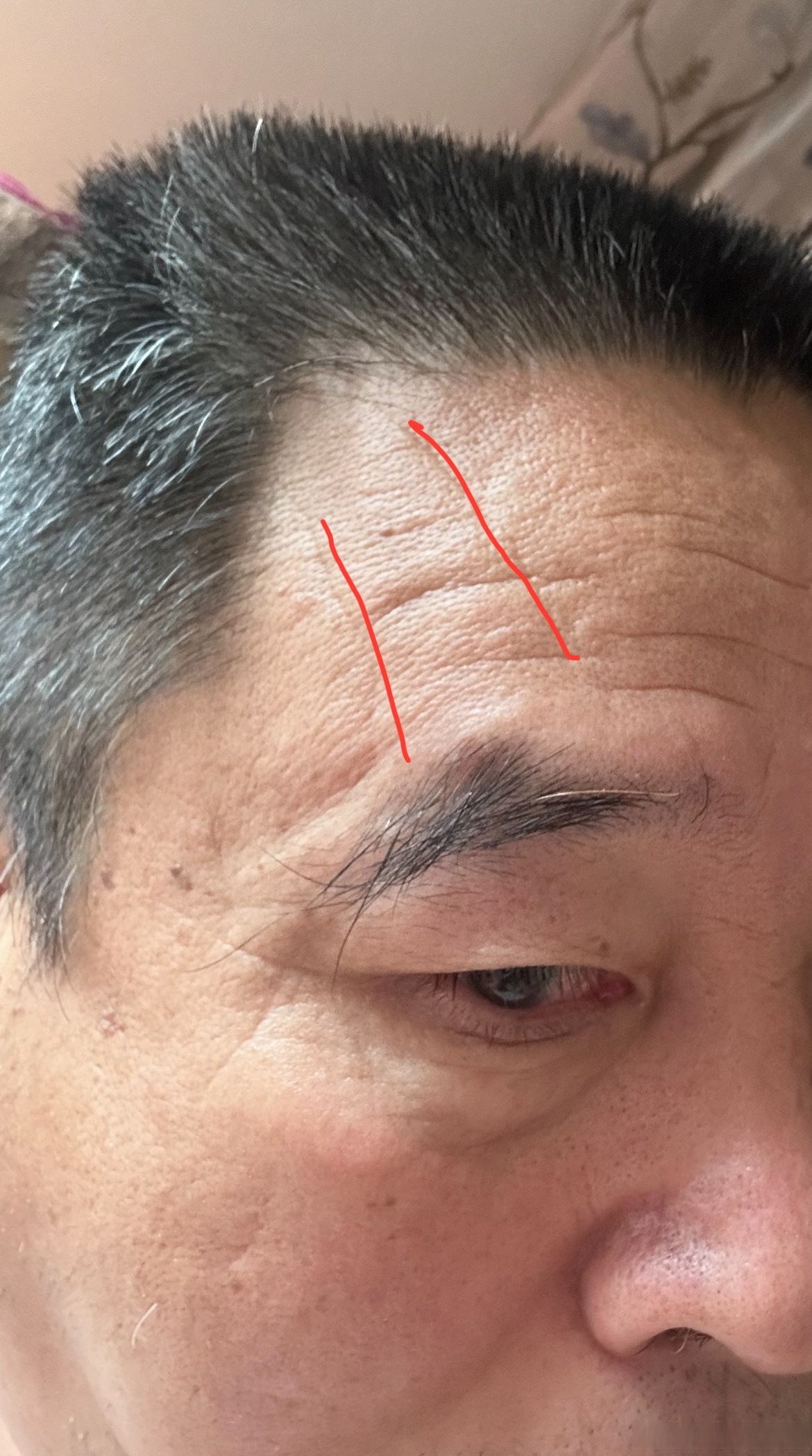 生活手记#记录一下我的额头右侧两道竖纹,练功前
