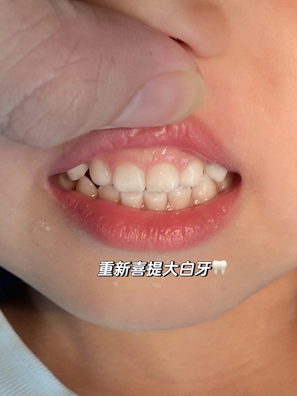 宝宝牙菌斑07|同款牙齿黑色素沉淀看过来98 最近发现哥哥两颗门牙