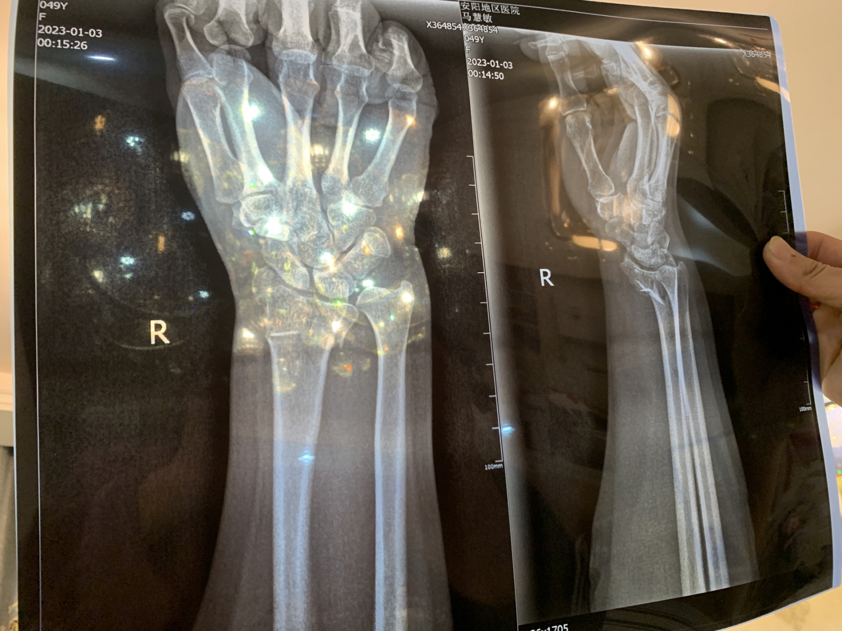 右手尺桡骨远端图片图片
