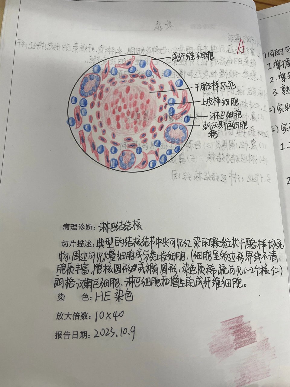 病理学|淋巴结结核红蓝铅笔绘图 淋巴结结核红蓝铅笔绘图